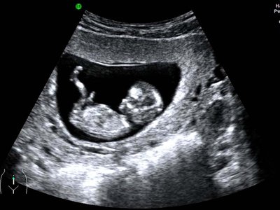 Ultrahang - Forrás: NHS.uk